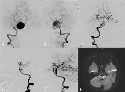 Endovascular Treatment of Large or Giant Basilar Artery Aneurysms Using the Pipeline Embolization Device: Complications and Outcomes